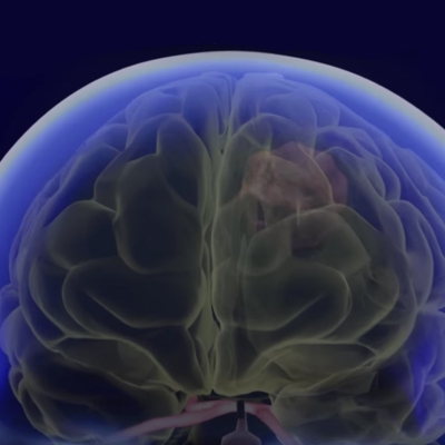 Brain Port Brain Surgery | Thumbnail