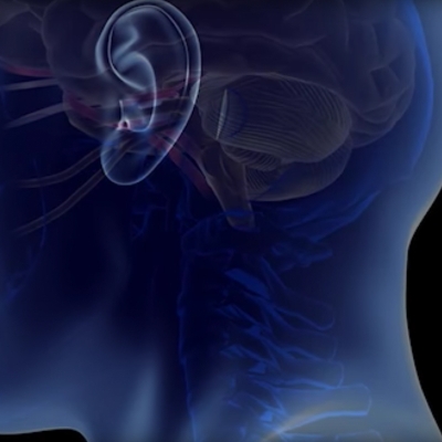 Endoscopic Microvascular Decompression | Thumbnail